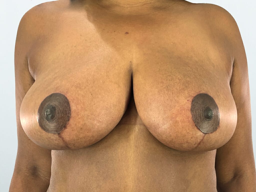 Woman 6 months after Bi-Lateral Breast Reduction and Breast Uplift surgery at Bella Vou
