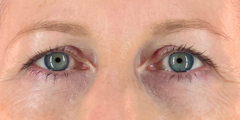Lateral Browlift and Upper Blepharoplasty Before photos