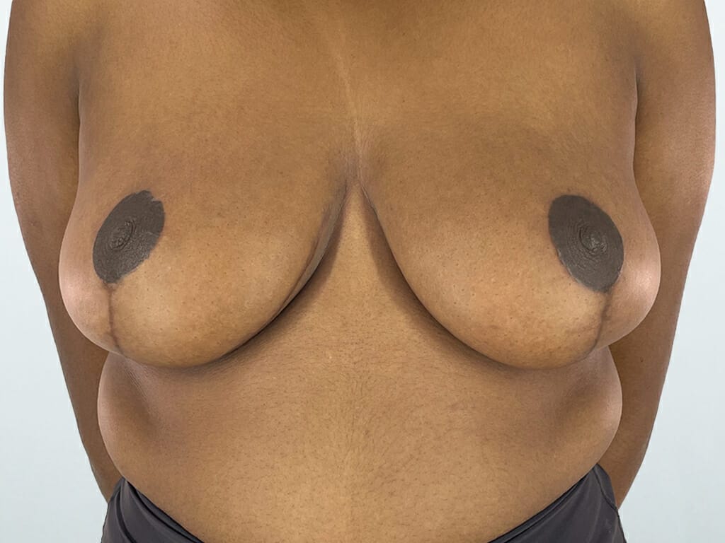 Woman 6 months after Breast Reduction and Breast Lift surgery at Bella Vou