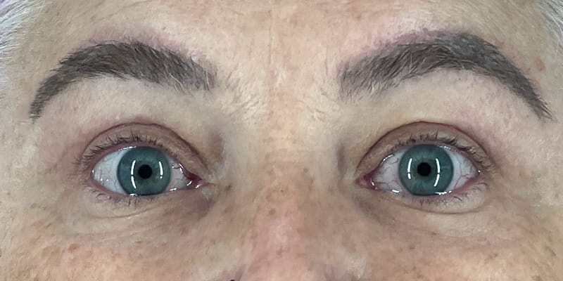Direct Browlift and Upper Blepharoplasty After Photo