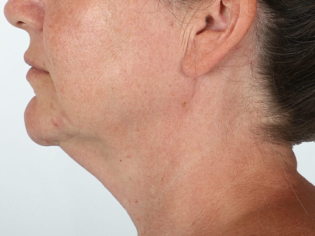 Woman before Deep Plane Neck Lift and Concept Face and Neck Lift surgery at Bella Vou