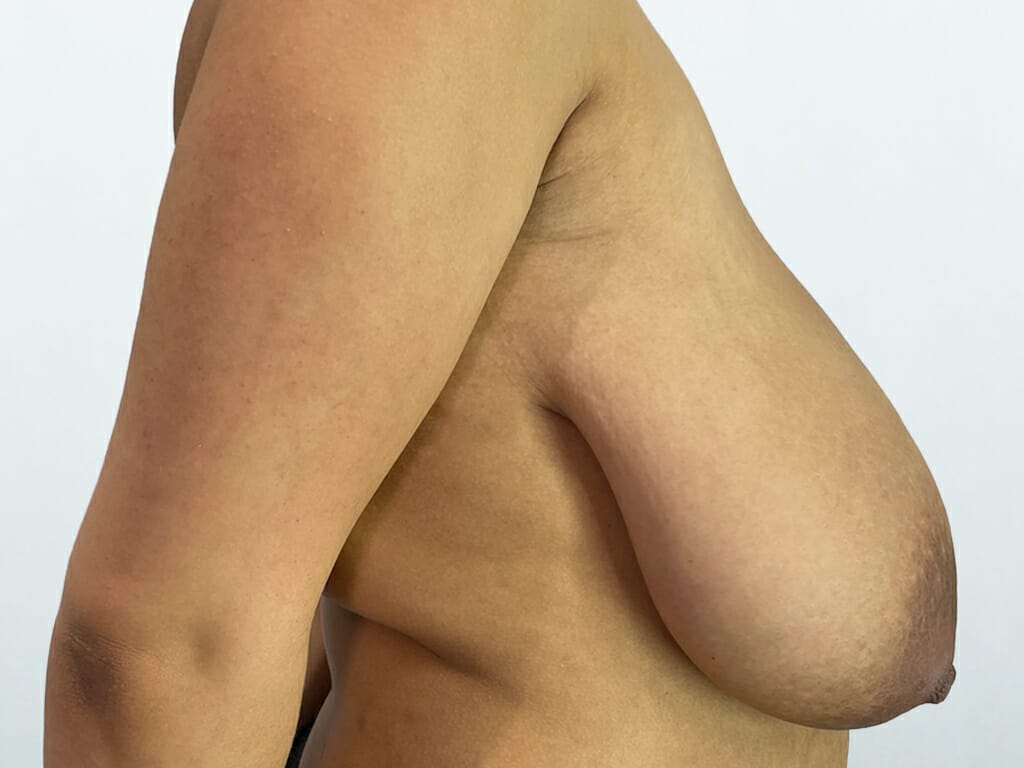 Woman before Breast Reduction and Breast Lift surgery at Bella Vou
