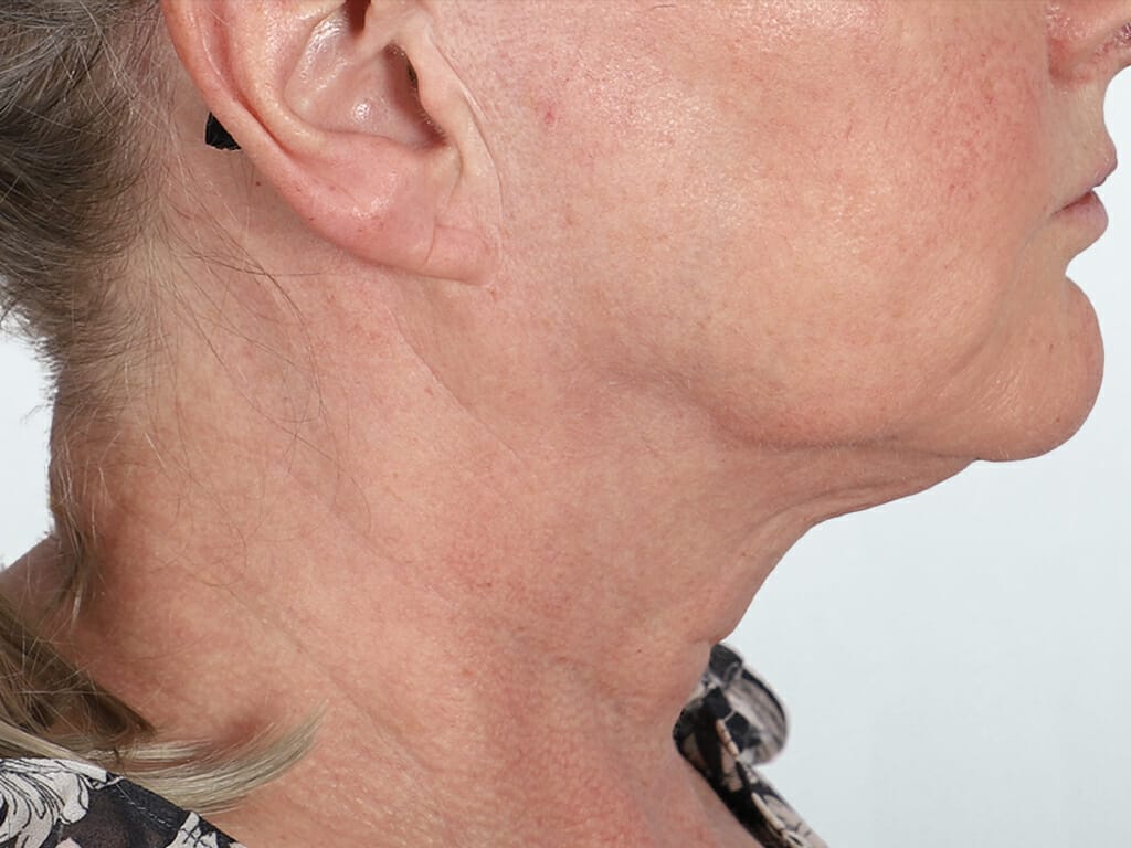 Woman before Deep Plane Neck Lift and Concept Face and Neck Lift surgery at Bella Vou