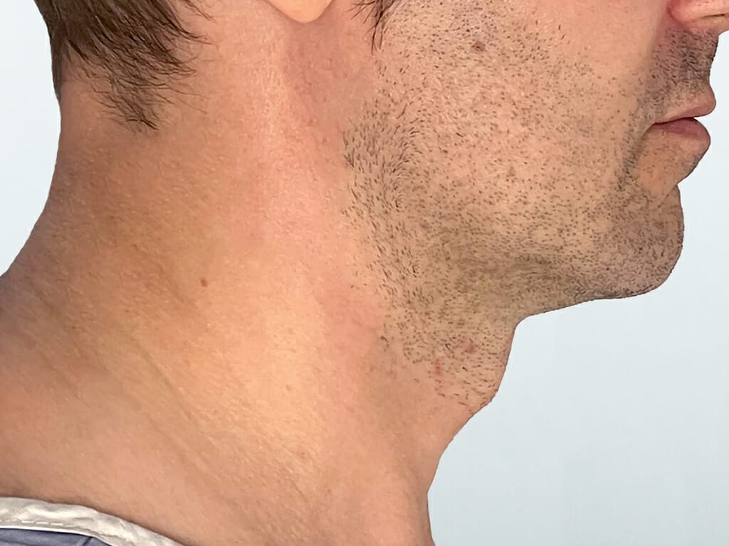 Man before Deep Plane Neck Lift, Concept Face and Neck Lift and Lip Lift surgery at Bella Vou