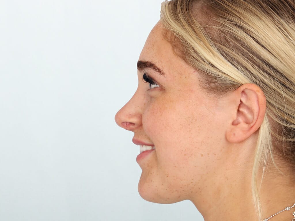 Woman 3 months after Rhinoplasty surgery at Bella Vou