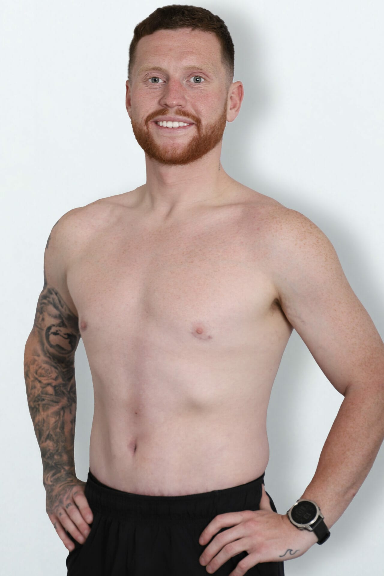 Ethan Payne 2 months after Circumferential Abdominoplasty surgery at Bella Vou