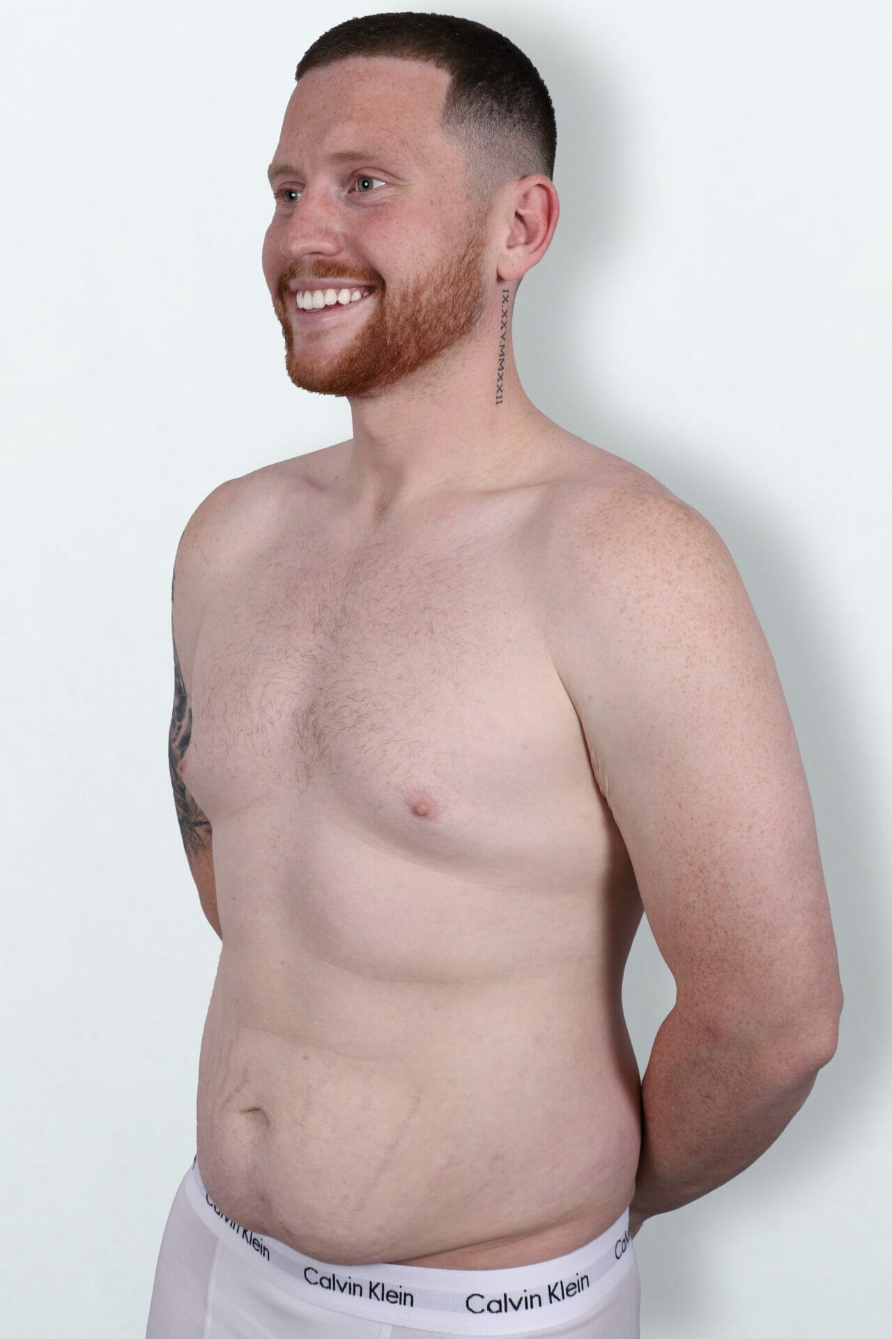 Ethan Payne before Circumferential Abdominoplasty surgery at Bella Vou