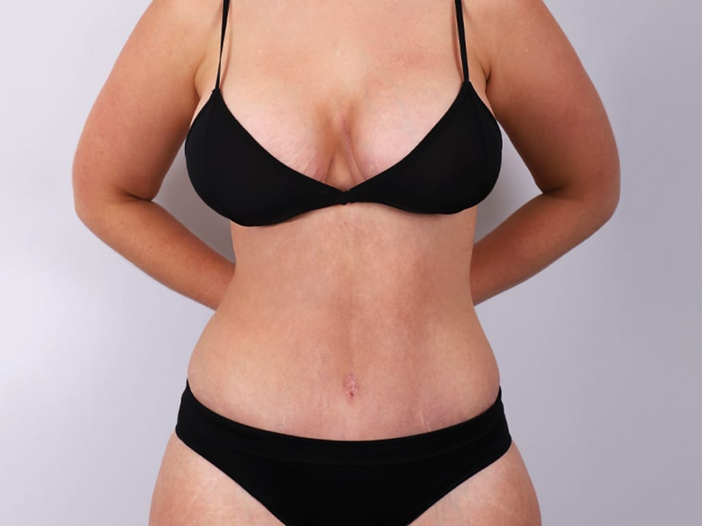 Circumferential Body Lift with Mastopexy and Breast Augmentation After Photo