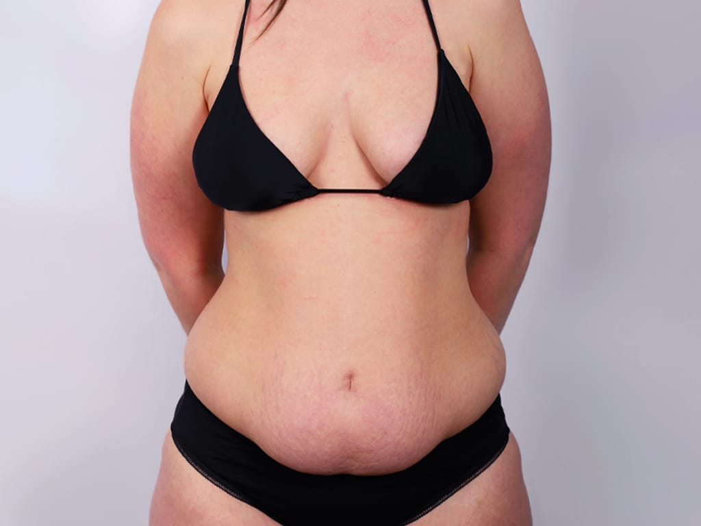 Circumferential Body Lift with Mastopexy and Breast Augmentation Before Photo
