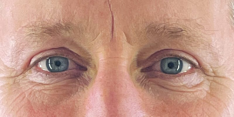 Browlift and Upper Blepharoplasty After Photo