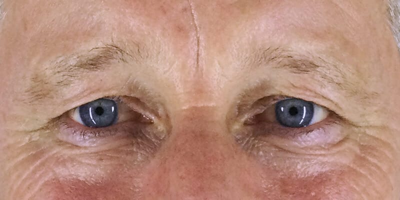 Browlift and Upper Blepharoplasty Before Photo