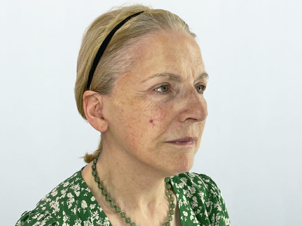 Woman 1 month after Extended Concept™ Face and Neck Lift with Upper Eyelid surgery at Bella Vou