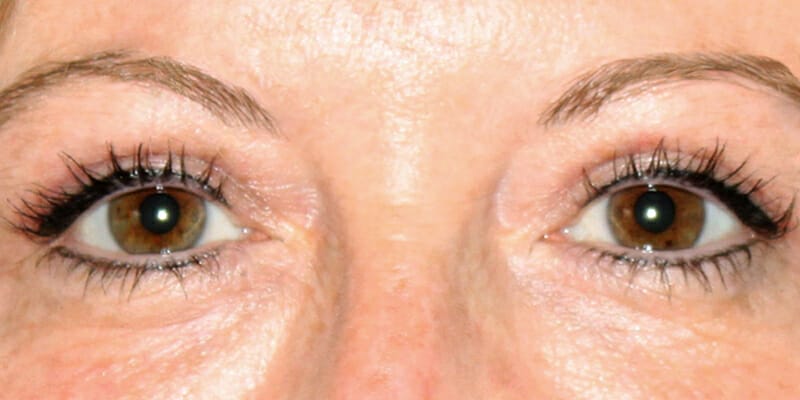 Woman 1 Month after upper eyelid surgery