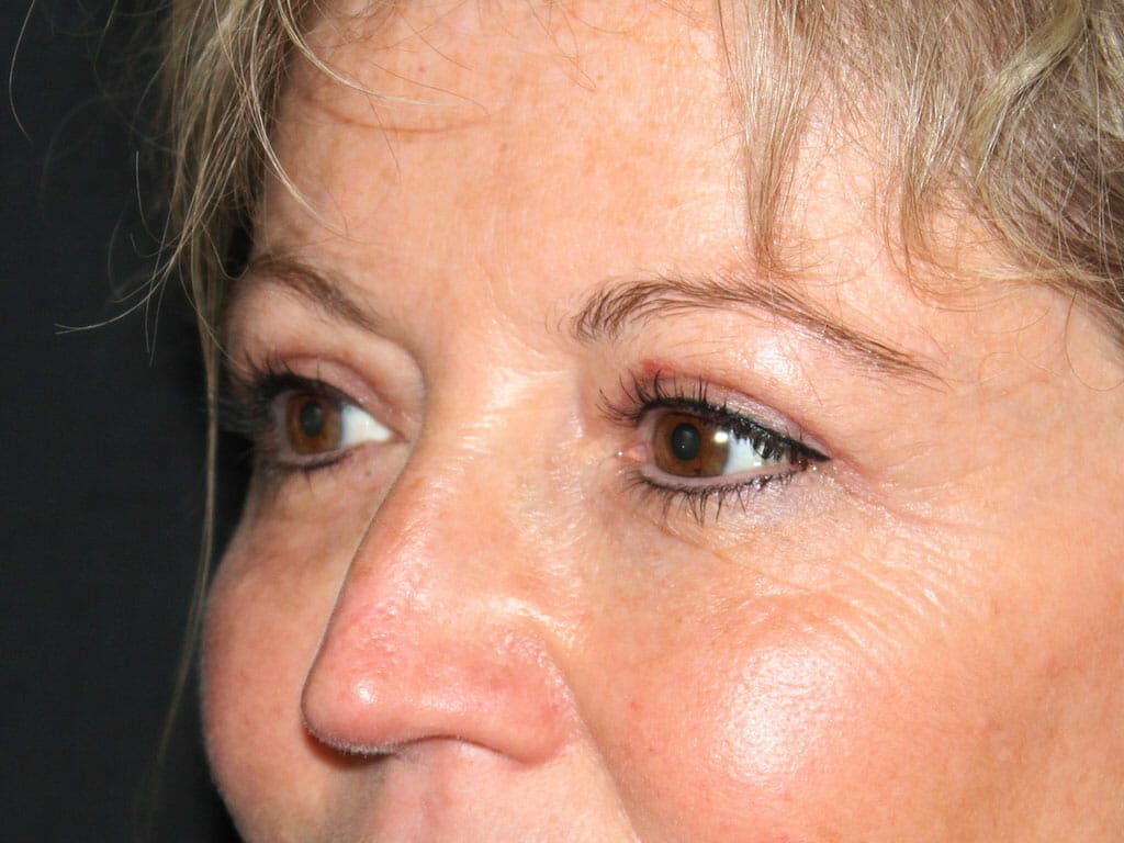 Ann one month after her Eyelid Surgery