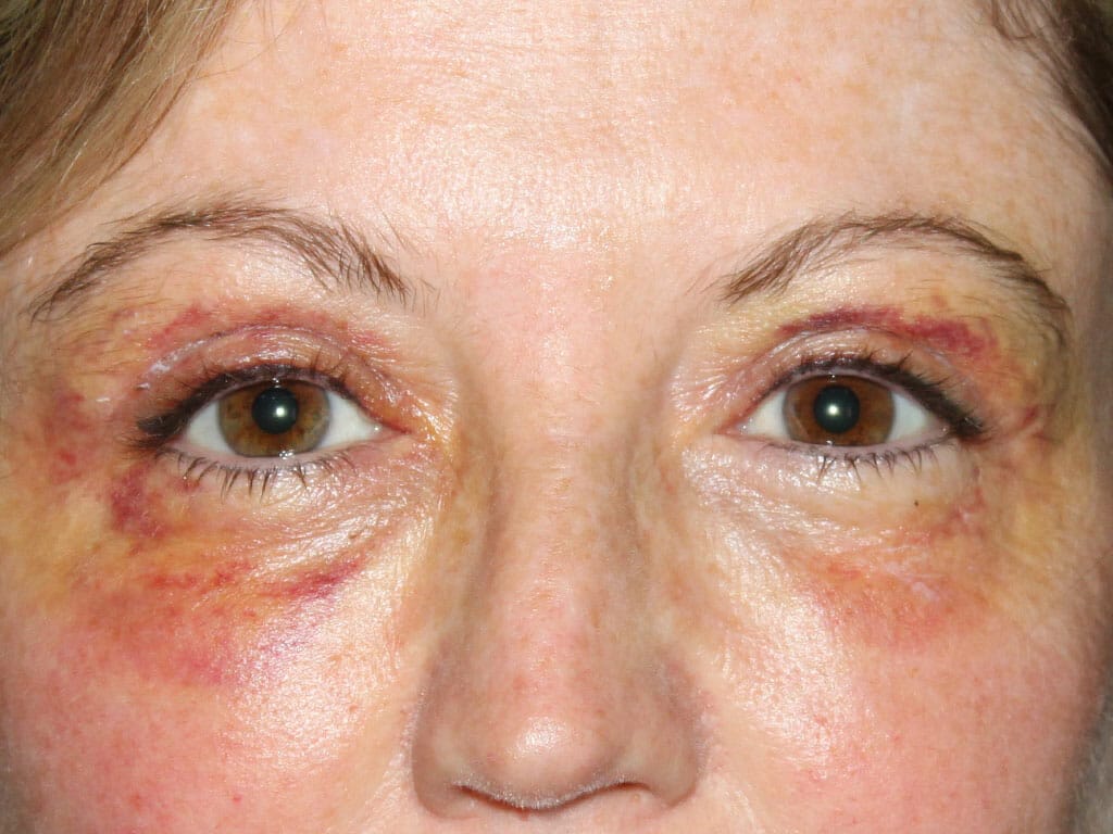 Ann one week after her Eyelid Surgery
