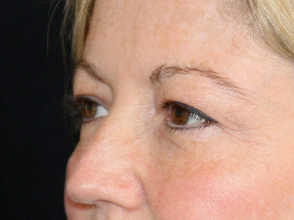 Ann before her Eyelid Surgery