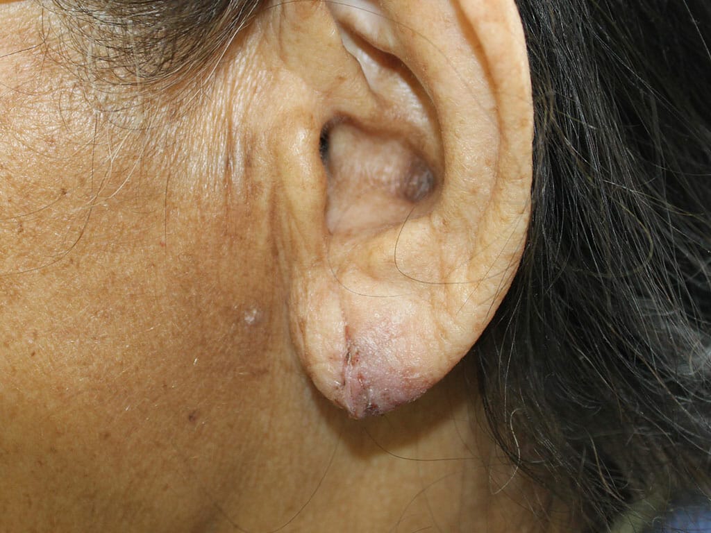 Earlobe Repair