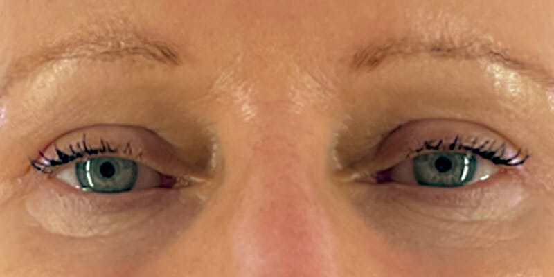 Woman 5 Months after upper eyelid surgery