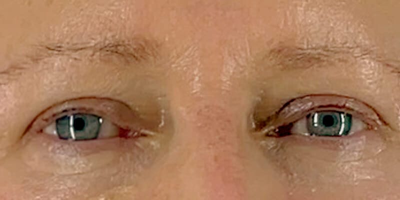 Woman before her upper eyelid surgery