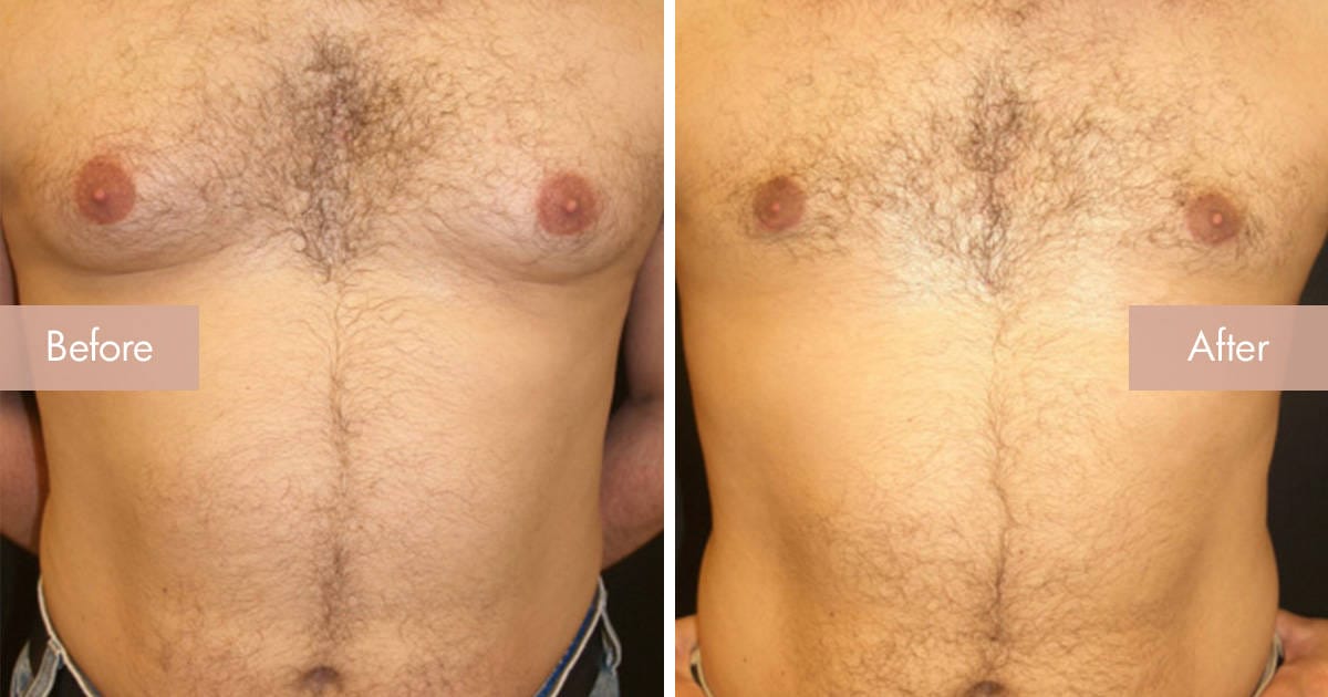 Male Breast Reduction (Gynaecomastia)
