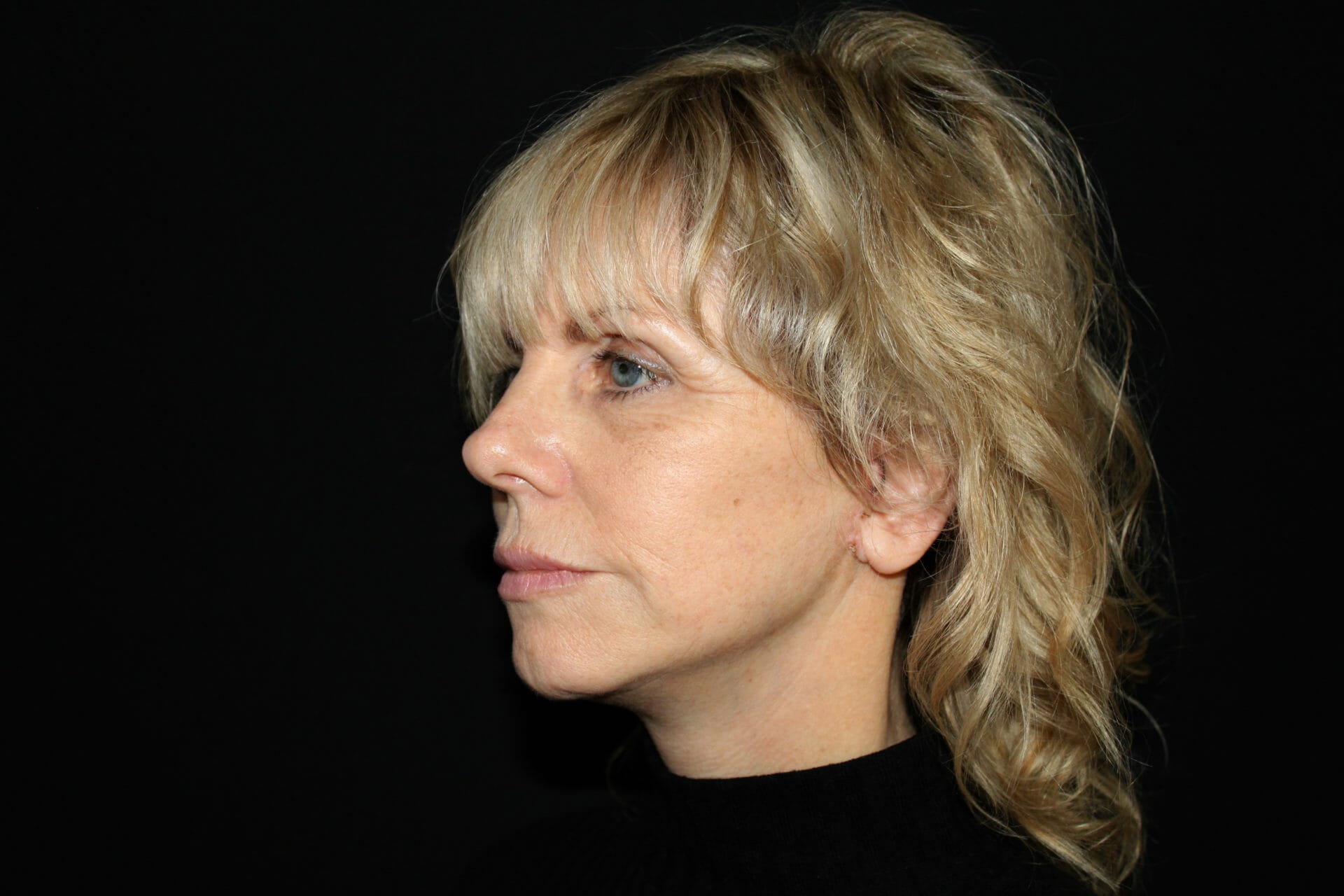 Christine-ConceptFacelift-After_3 Christine after her Concept™ Facelift surgery