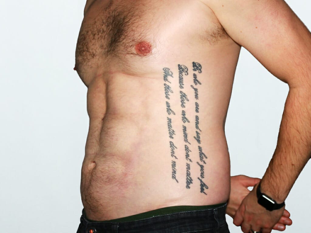 Man 4 Months after Vaser Liposculpting to the abdomen at Bella Vou