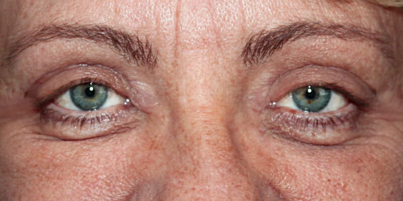 Woman 1 week after upper eyelid surgery