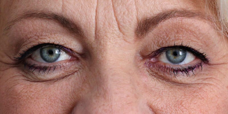 Woman before her upper eyelid surgery