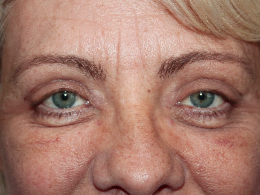 Gabrielle one week after her Eyelid Surgery