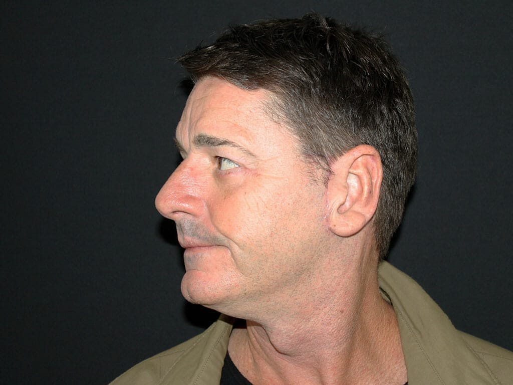 Gary one month after his Concept Facelift