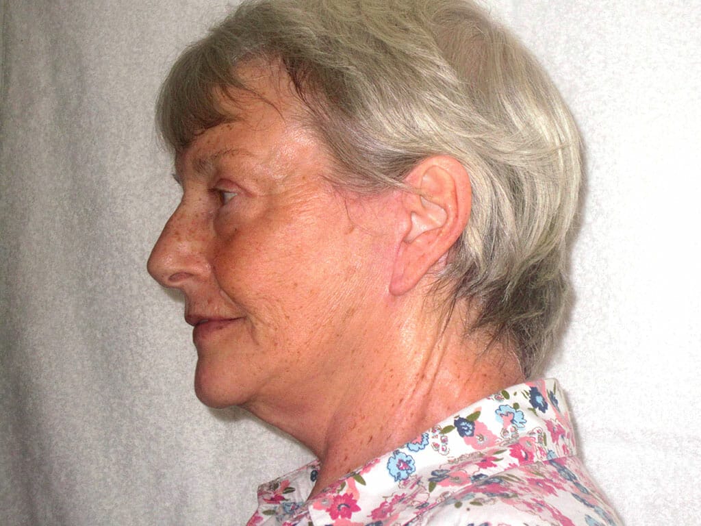 Helen one month after her Concept Facelift