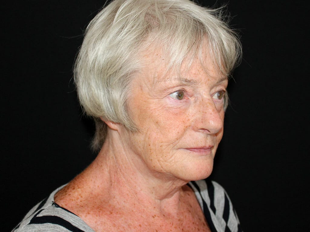 Helen before her Concept Facelift