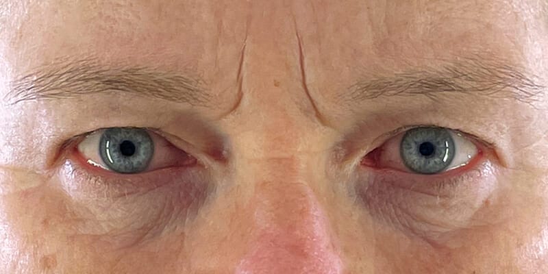 Direct Browlift and Upper Blepharoplasty Before Photo