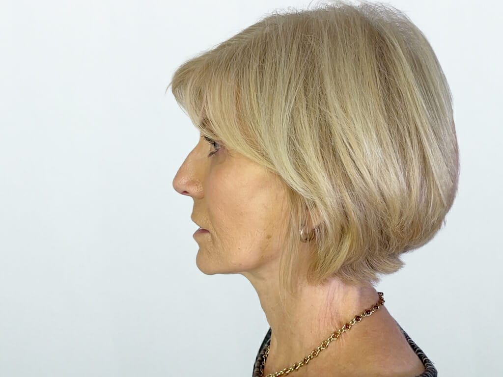 Woman 6 Weeks after Extended Concept™ Face and Neck Lift surgery at Bella Vou