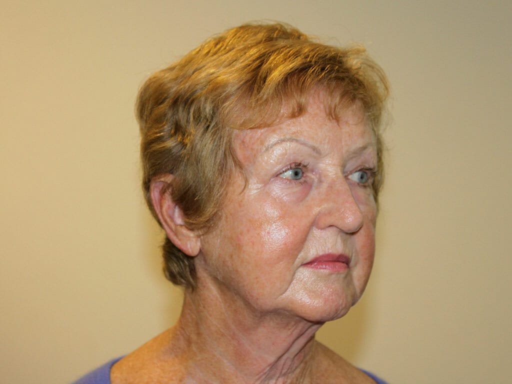 Jacqui before her Concept Facelift and Eyelid Surgery