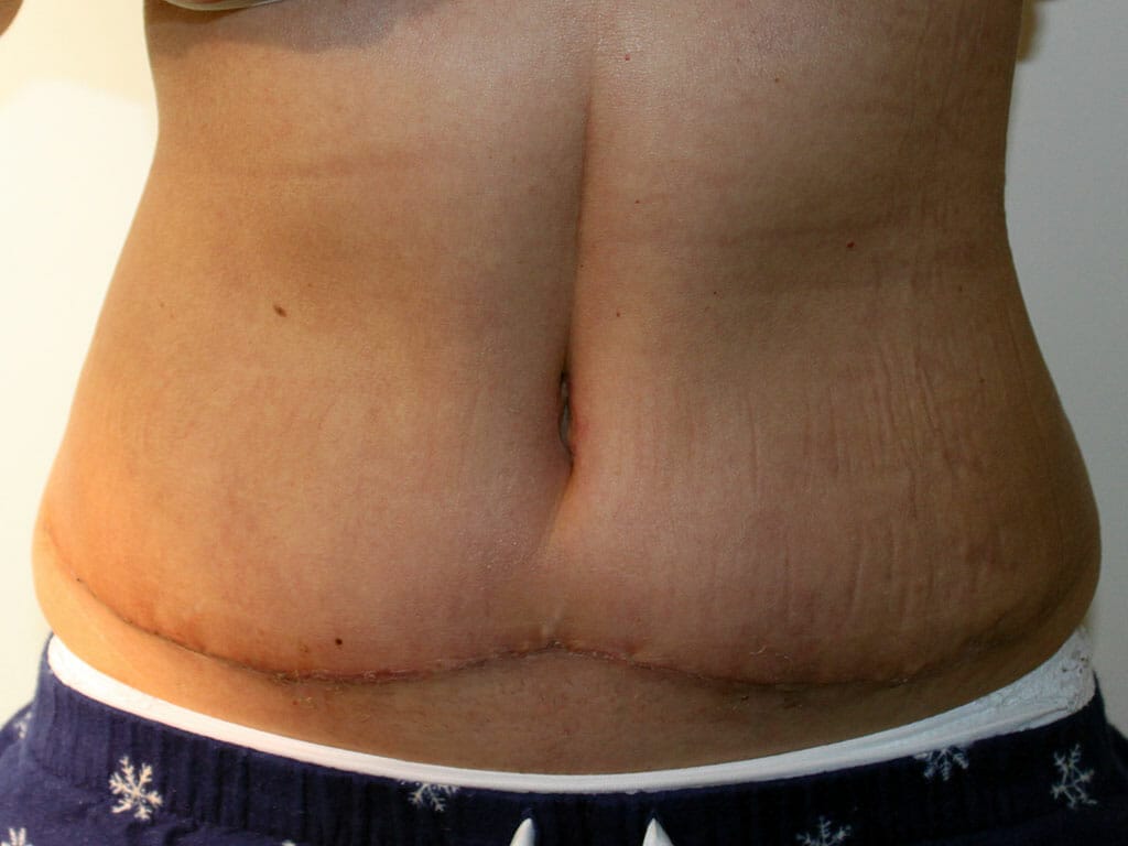 Jane one week after her Tummy Tuck
