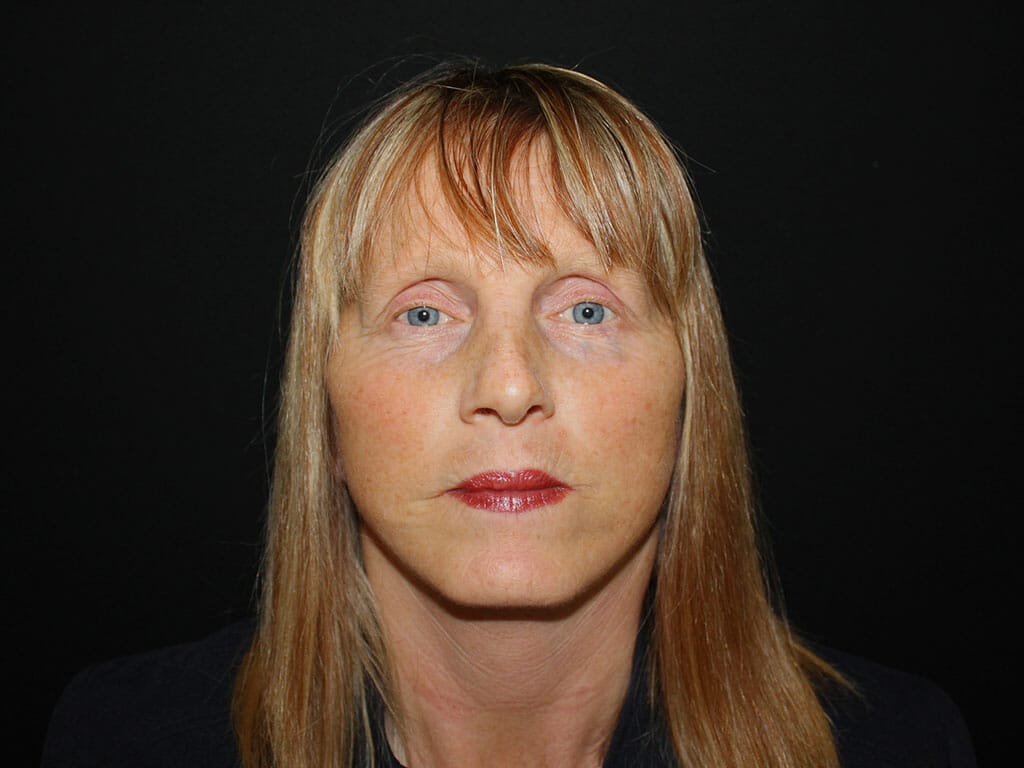 Joanne one hour after her Concept Facelift
