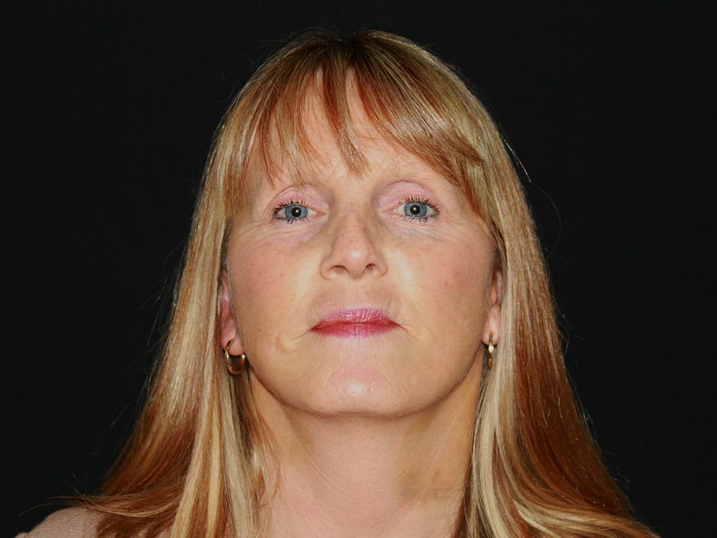 Joanne one week after her Concept Facelift