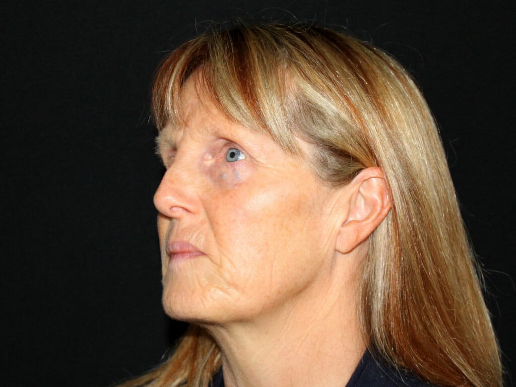 Joanne before her Concept Facelift