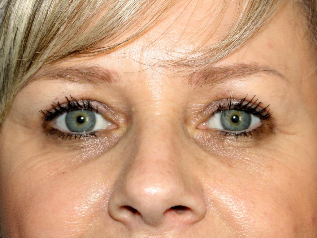 Joanne one month after her Eyelid Surgery