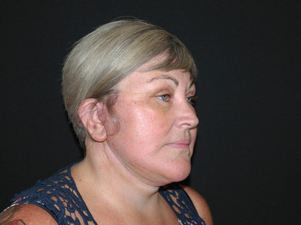 Julia one week after her Concept Facelift