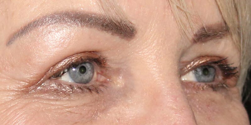 Woman 1 Month after Upper Eyelid surgery