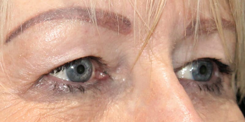 Woman before upper eyelid surgery