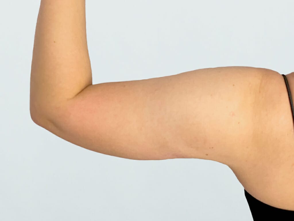 Woman 6 months after Vaser Liposuction to the arms at Bella Vou