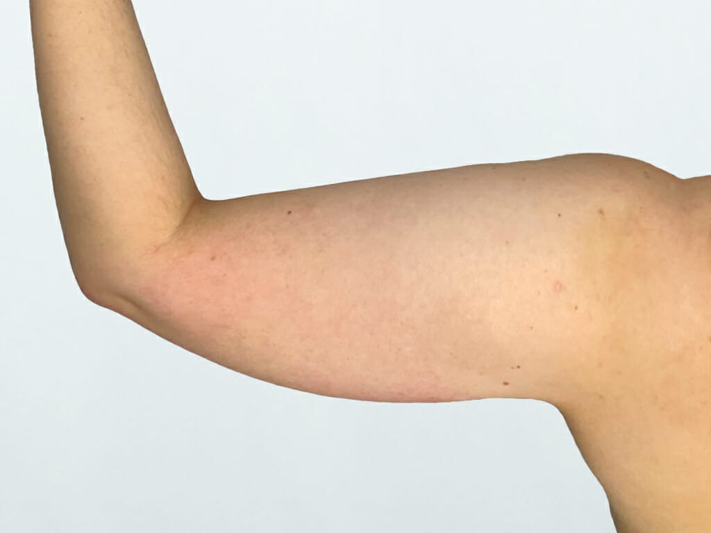 Woman before Vaser Liposuction to the arms at Bella Vou