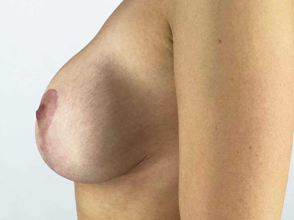Woman 6 weeks after Breast Uplift and Breast Implants surgery
