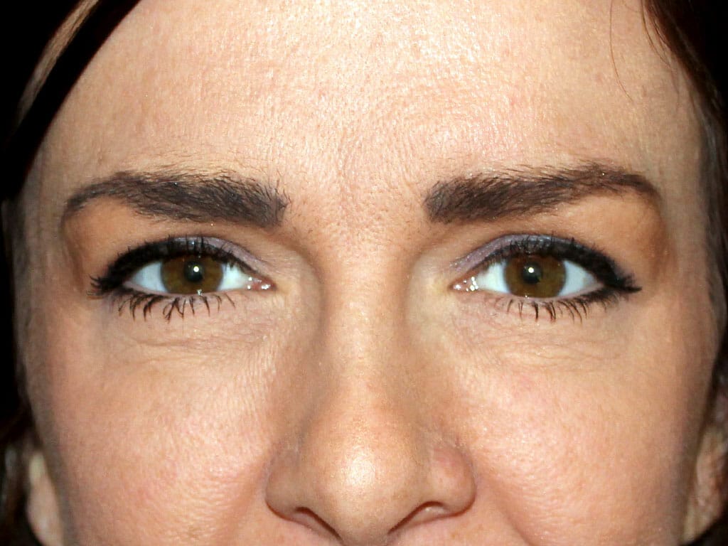 Leanne one month after her Eyelid Surgery