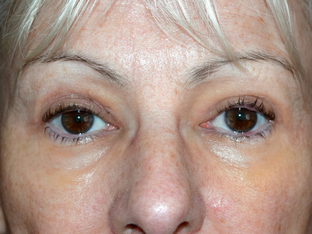 Marion one week after her Eyelid Surgery
