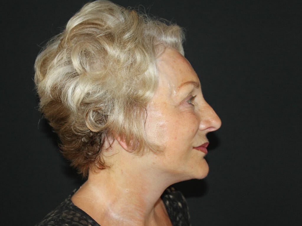 Maureen one hour after her Concept Facelift