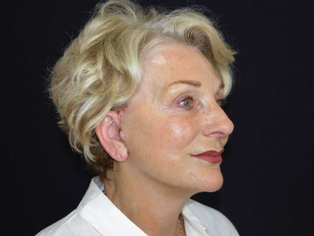 Maureen one week after her Concept Facelift